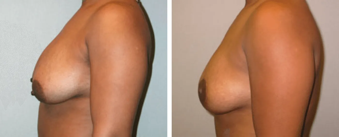 Breast lift c