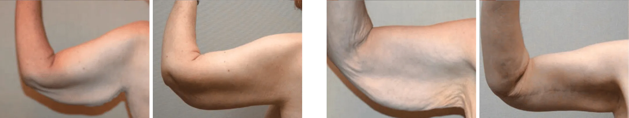 Best Arm Lift In Michgian ()
