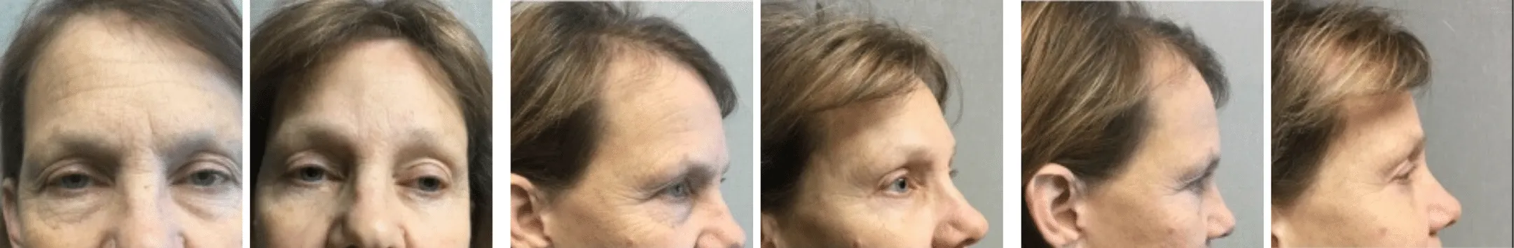 Best Brow Lift In Michigan ()
