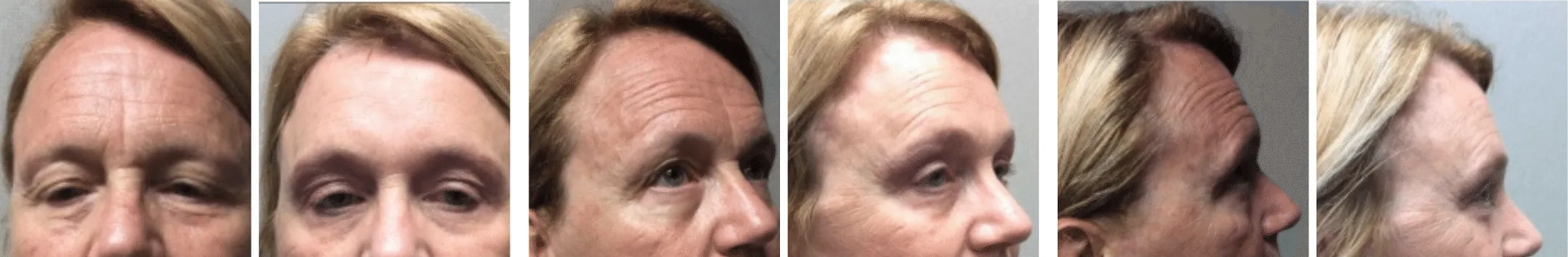 Best Brow Lift In Michigan