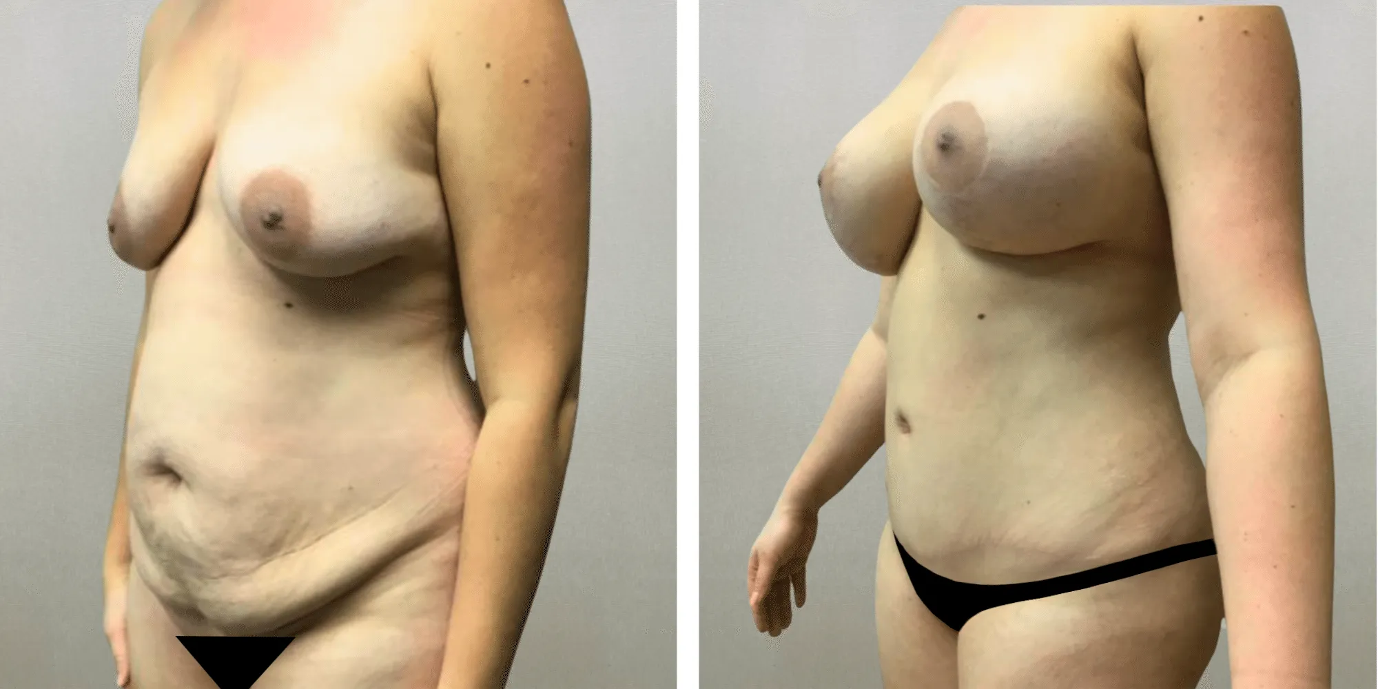 Best Mommy Makeover in Detroit ()