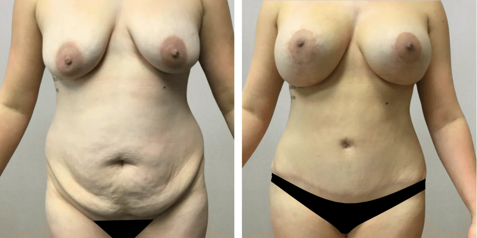 Best Mommy Makeover in Detroit