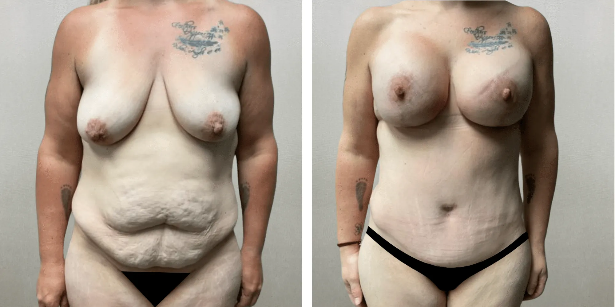 Best Mommy Makeover in Michigan