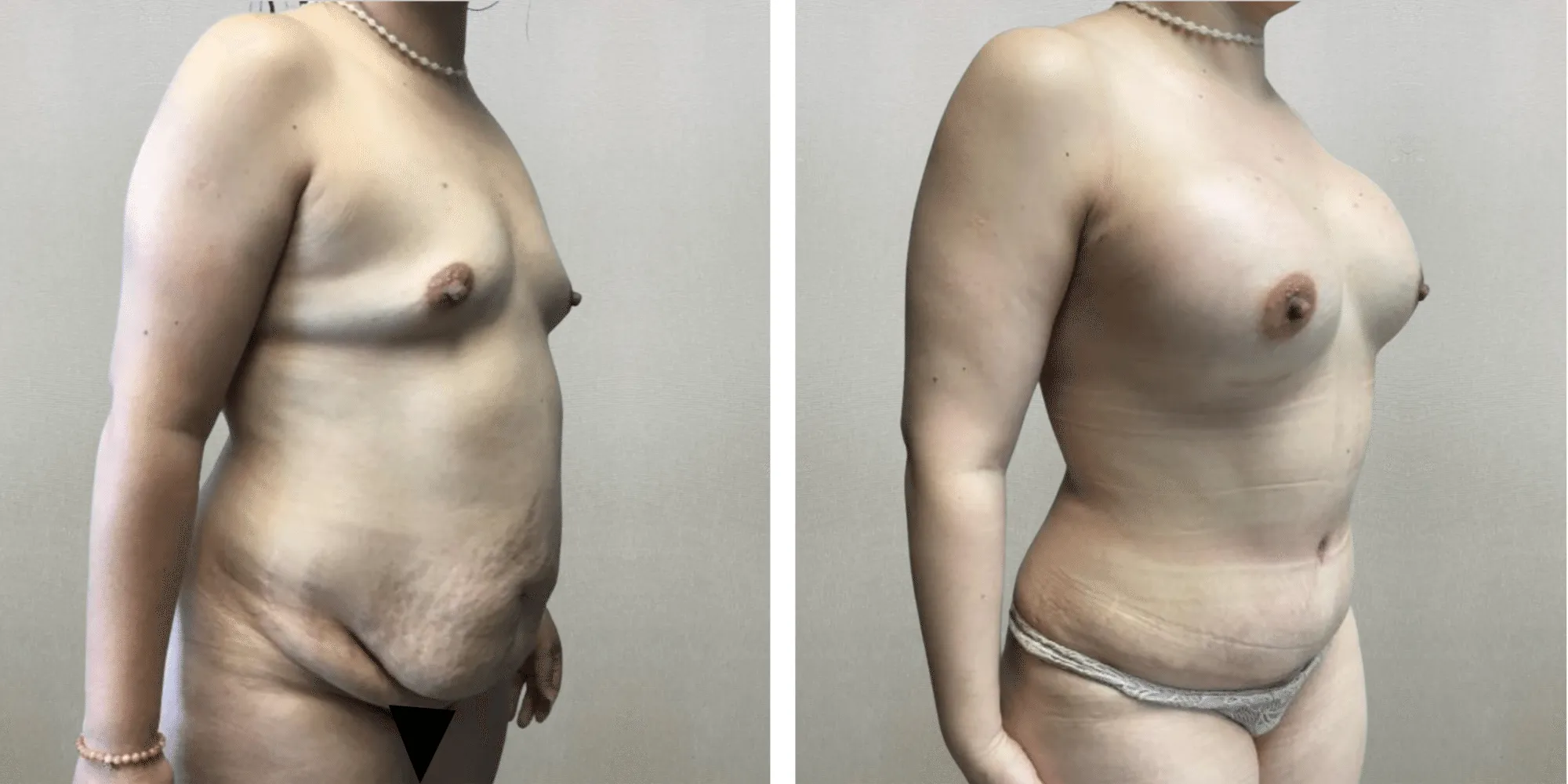 Best Mommy Makeover in Soutfield Michigan ()