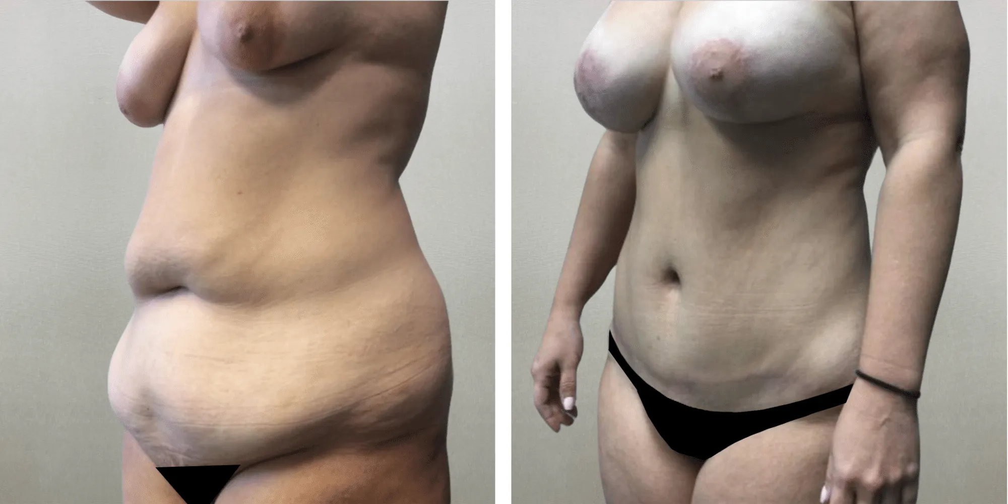 Best Mommy Makeover in Southfield Michigan ()