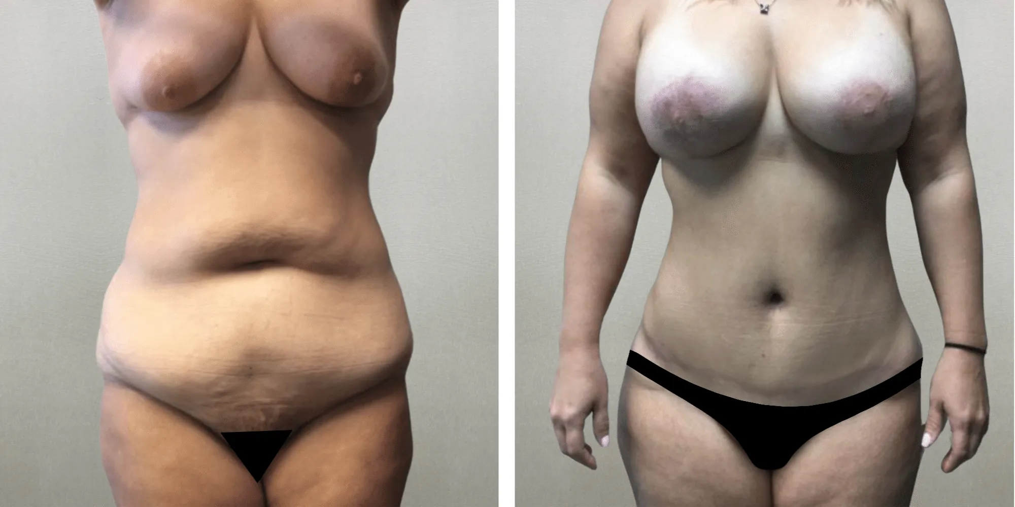 Best Mommy Makeover in Southfield Michigan