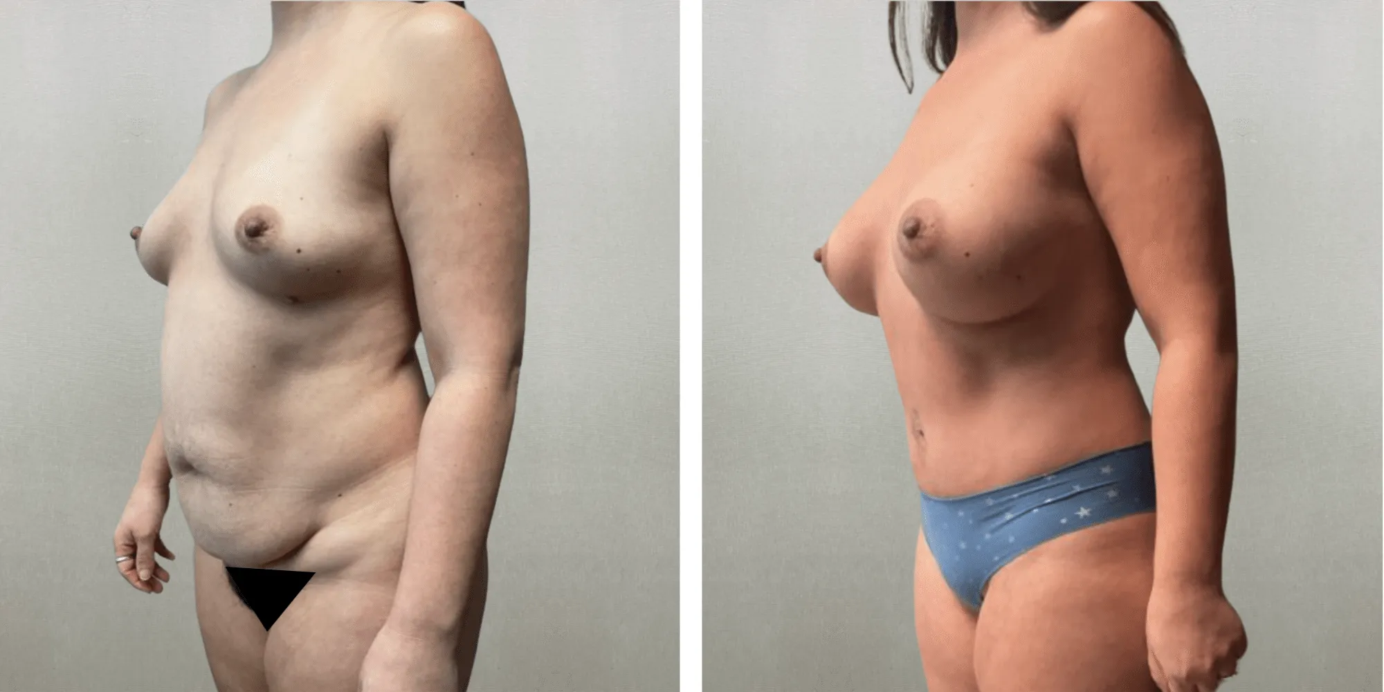 Best Mommy Makeover in Troy Michigan ()
