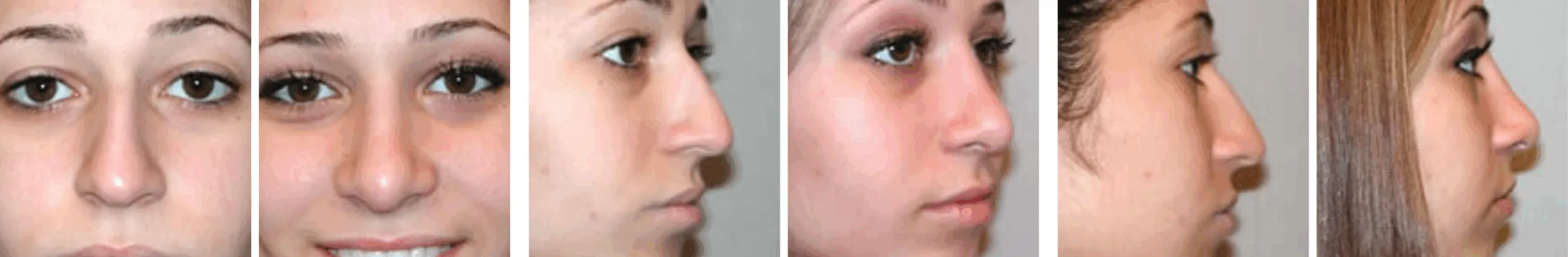 Best Rhinoplasty in Michigan ()