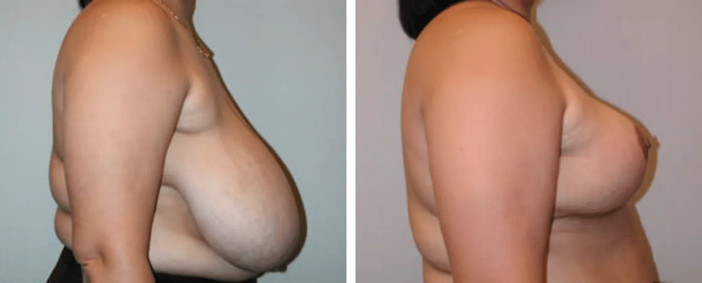 Breast Reduction C