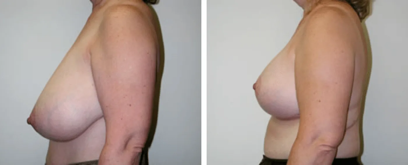 Breast Reduction C