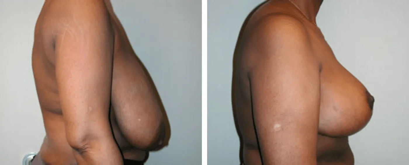 Breast Reduction C