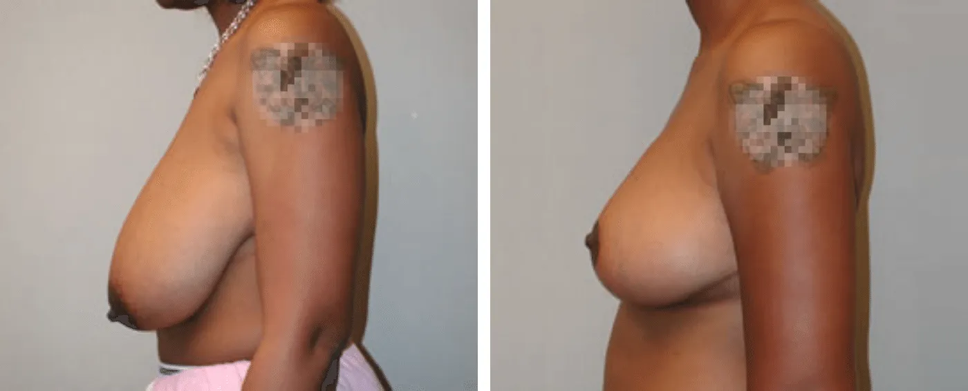 Breast Reduction C