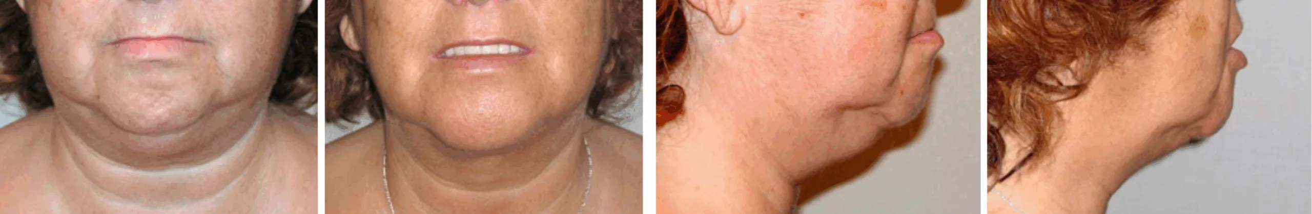 Chin Lipo In Michigan