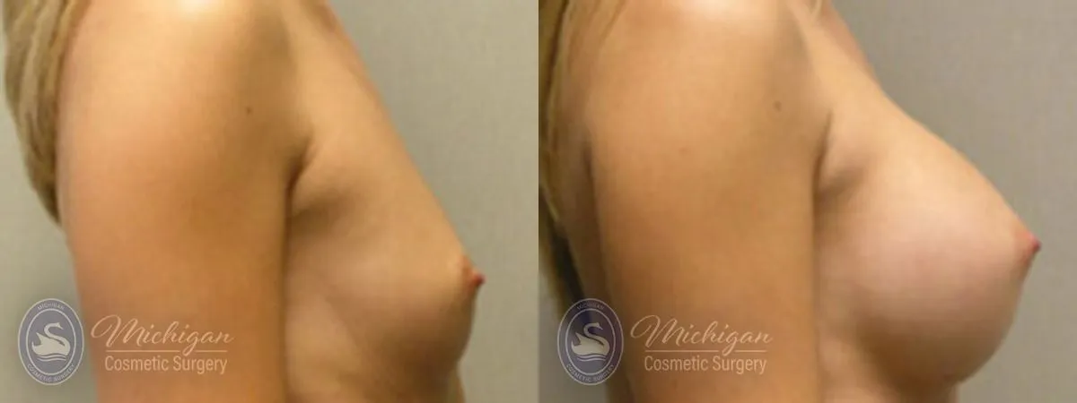 Michigan Cosmetic Surgery Southfield Breast Augmentation P