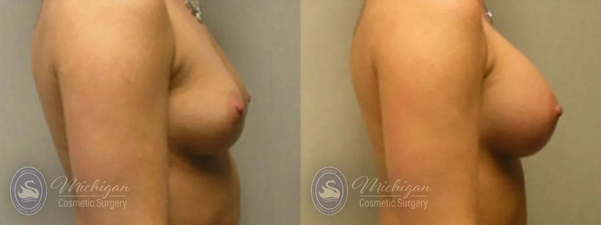 Michigan Cosmetic Surgery Southfield Breast Augmentation P
