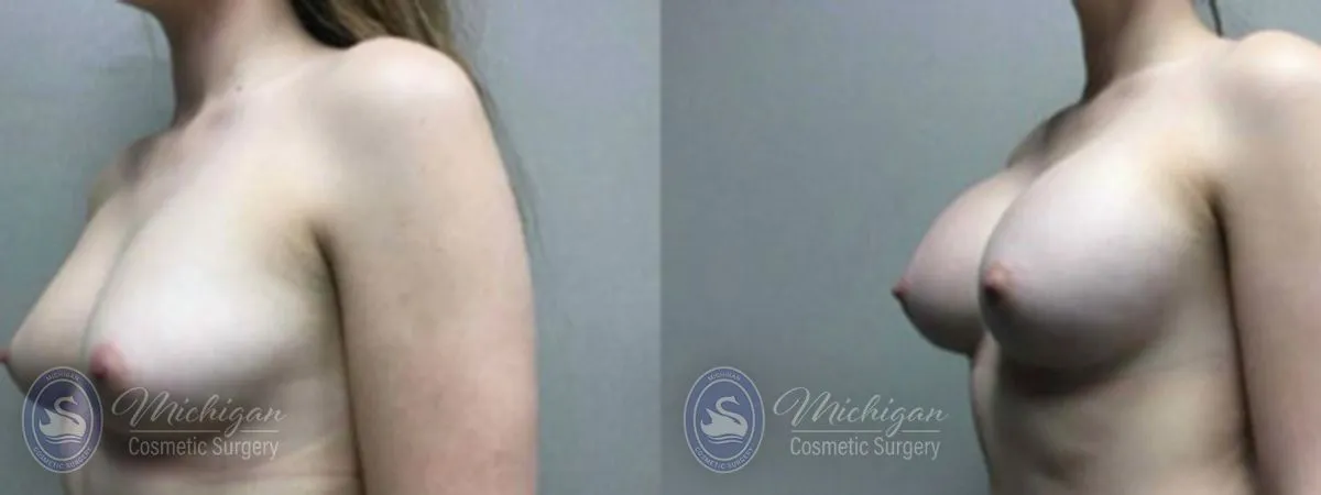 Michigan Cosmetic Surgery Southfield Breast Augmentation P