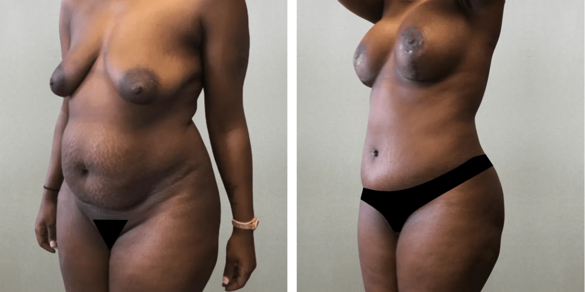 Mommy Makeover at michigagn Cosmetic Surgery ()