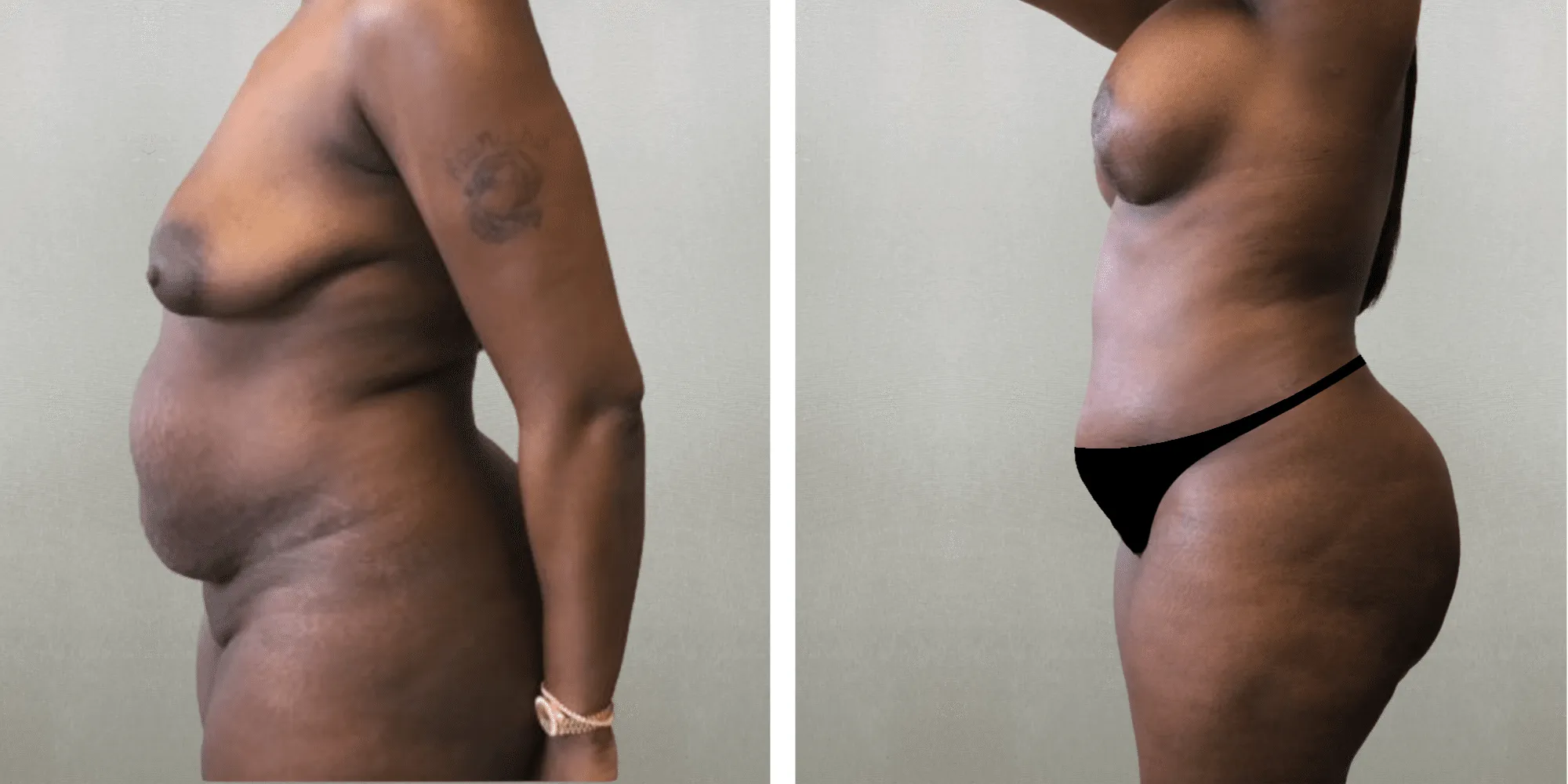 Mommy Makeover at michigagn Cosmetic Surgery ()