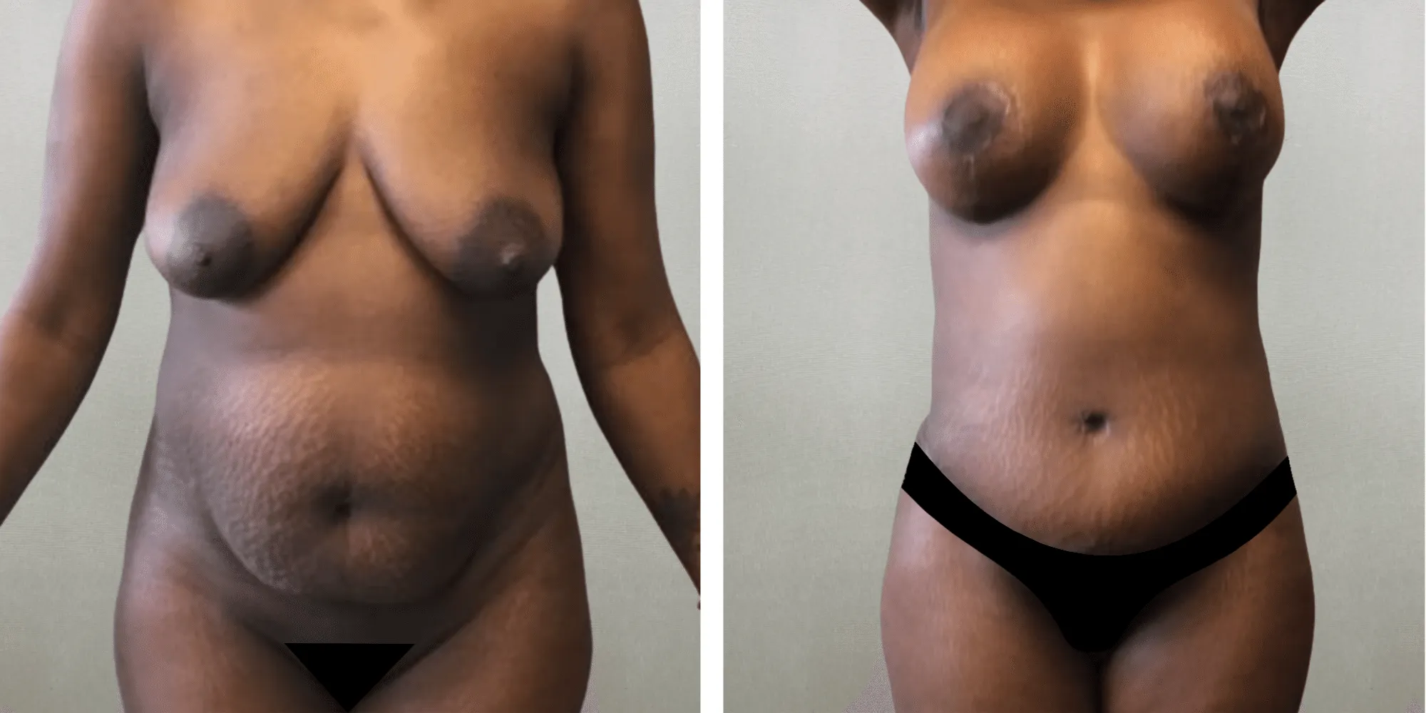 Mommy Makeover at michigagn Cosmetic Surgery