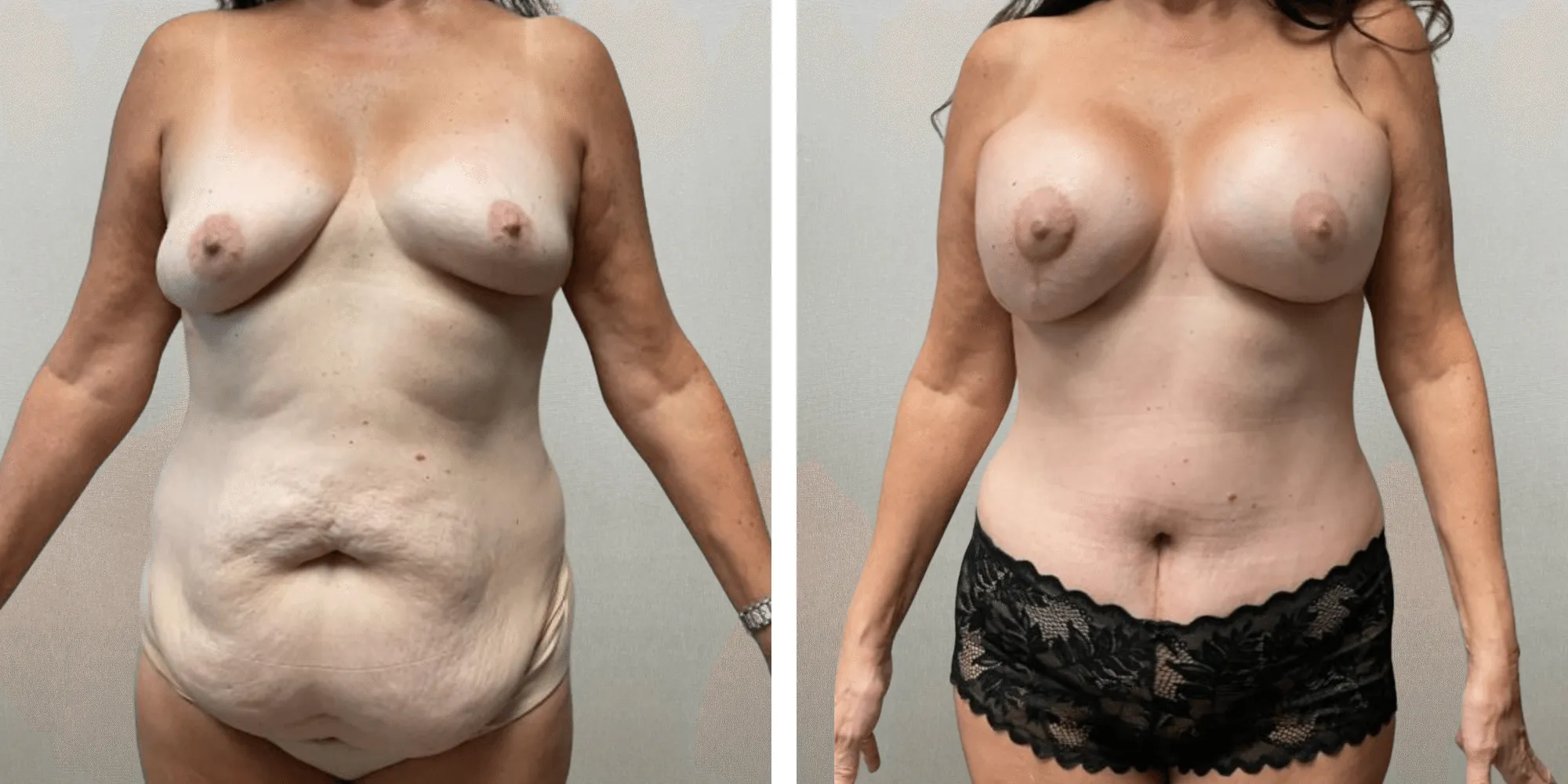 Mommy Makeover in Detroit, Before and After