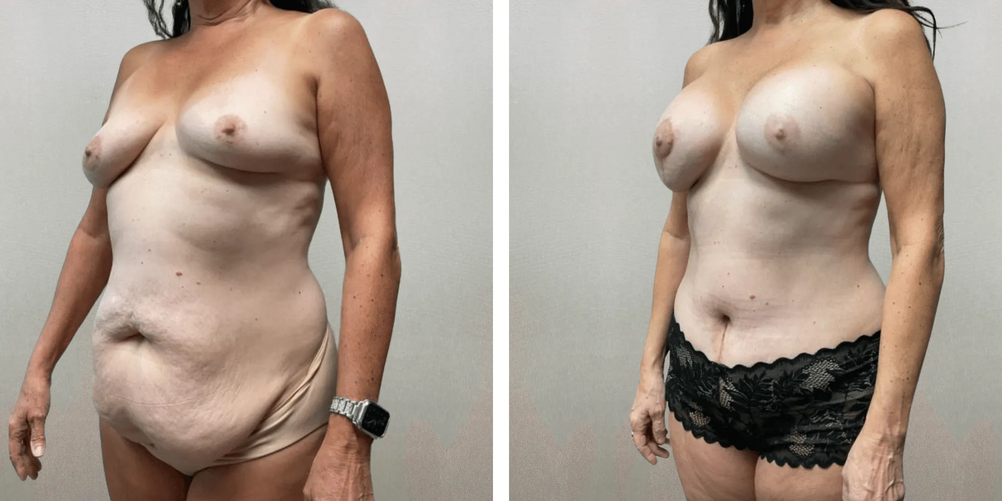 Mommy Makeover in Detroit, Before and After ()