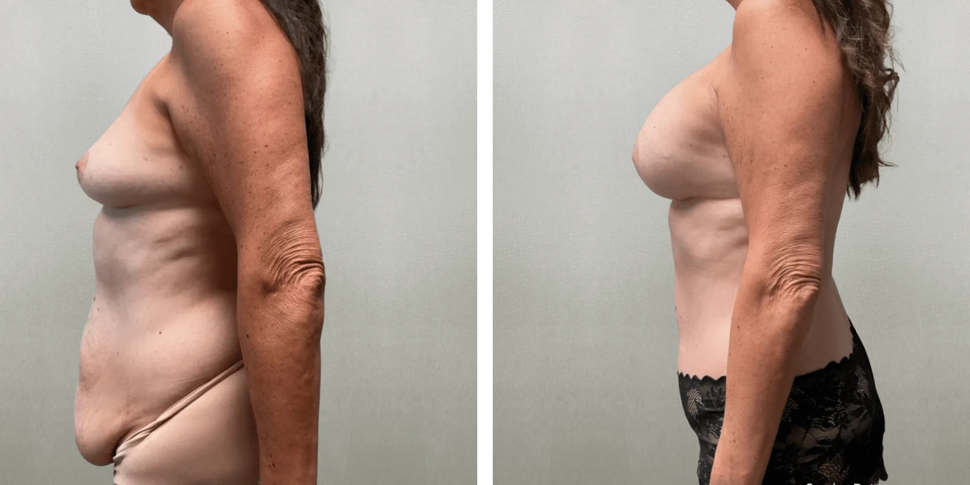 Mommy Makeover in Detroit, Before and After ()
