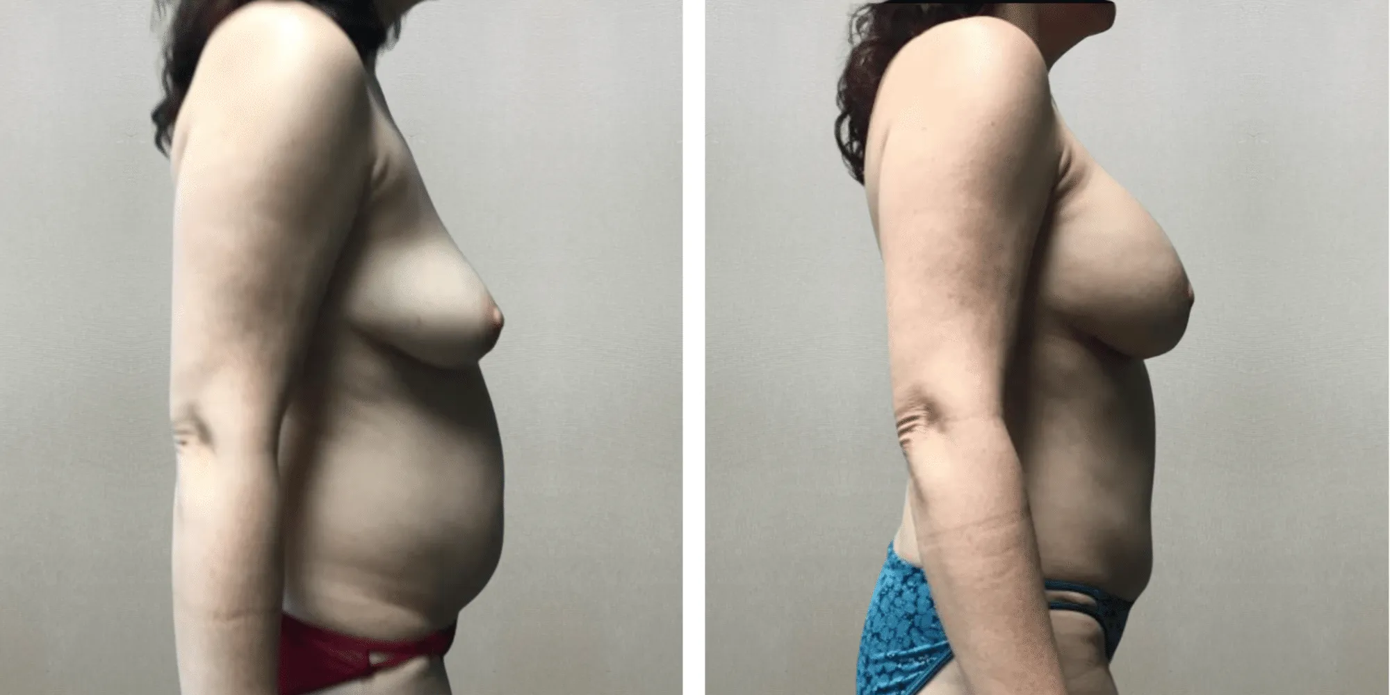 Mommy Makeover in Detroit Michigan ()