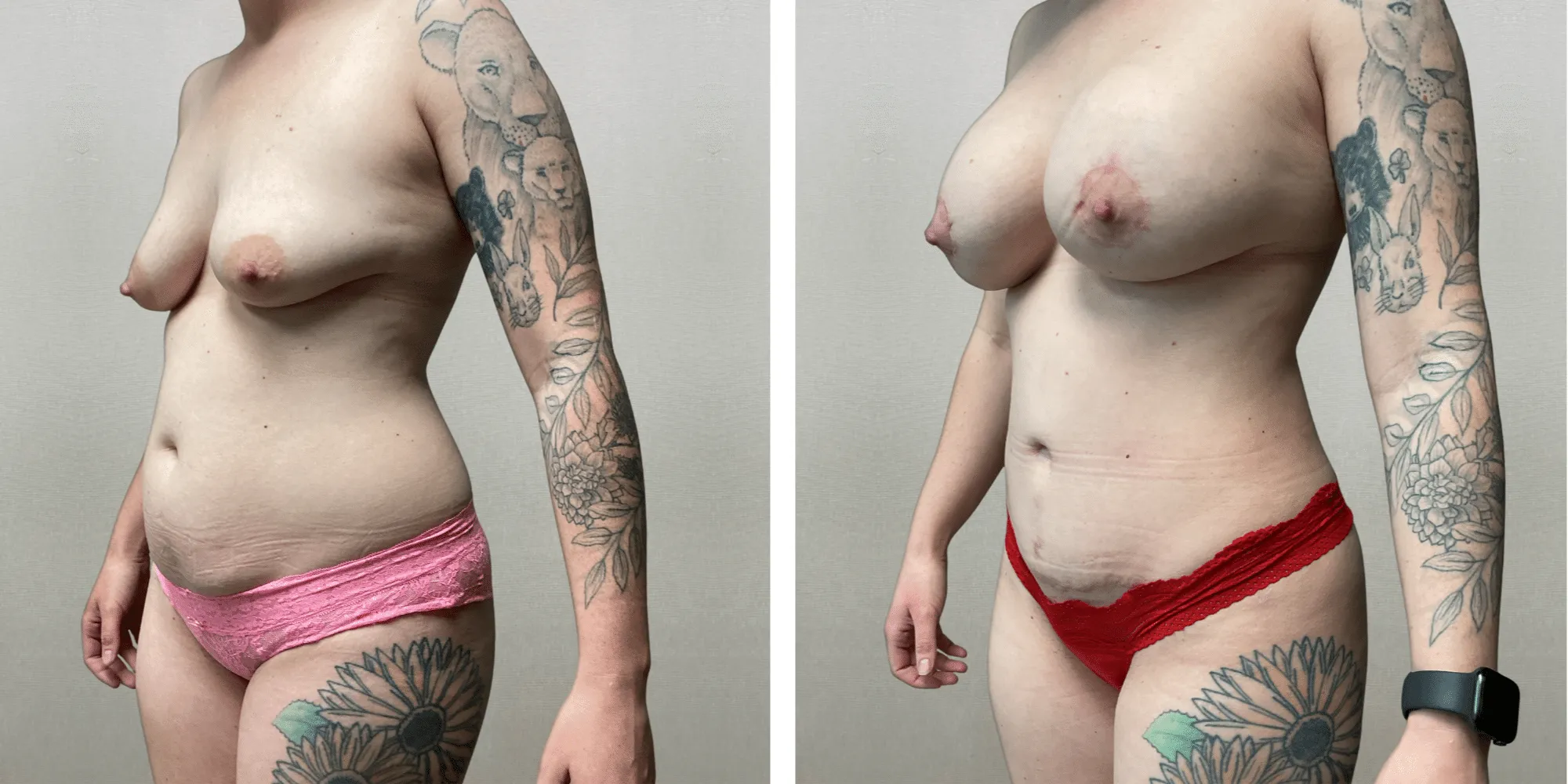 Mommy Makeover in Detroit metro ()
