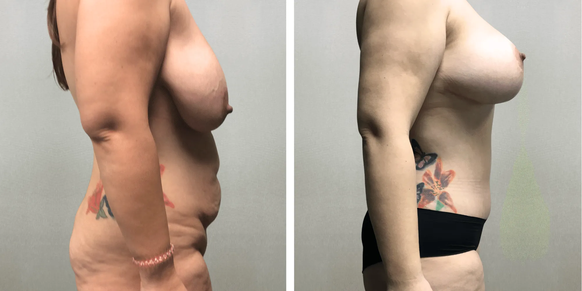 Mommy Makeover with Tummy Tuck and breast reduction