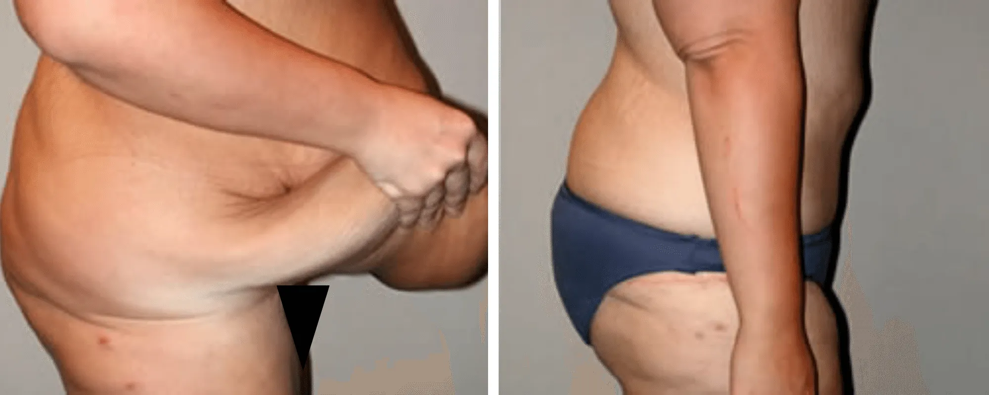 Weight Loss Makeover Body Lift in Michigan ()