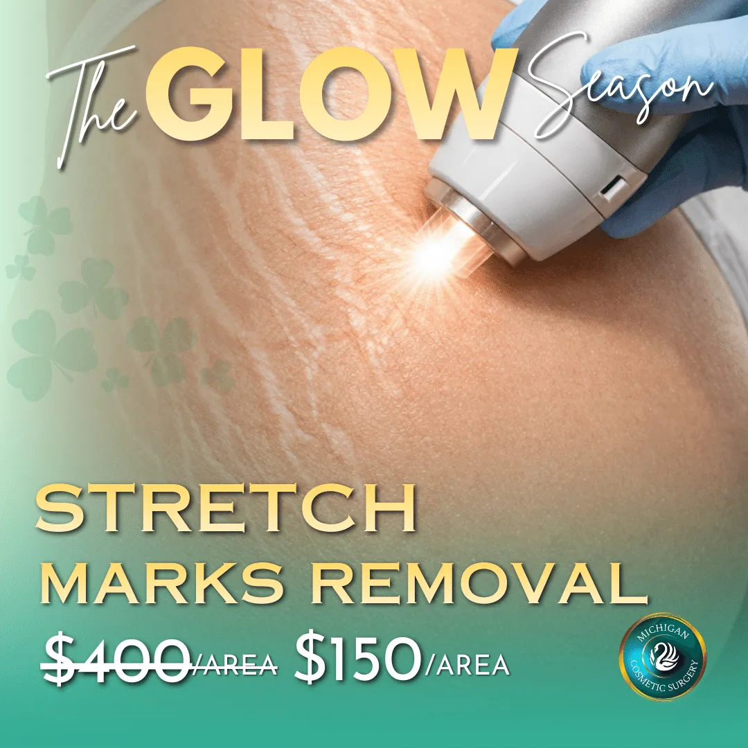 Stretch Marks Removal in Michigan